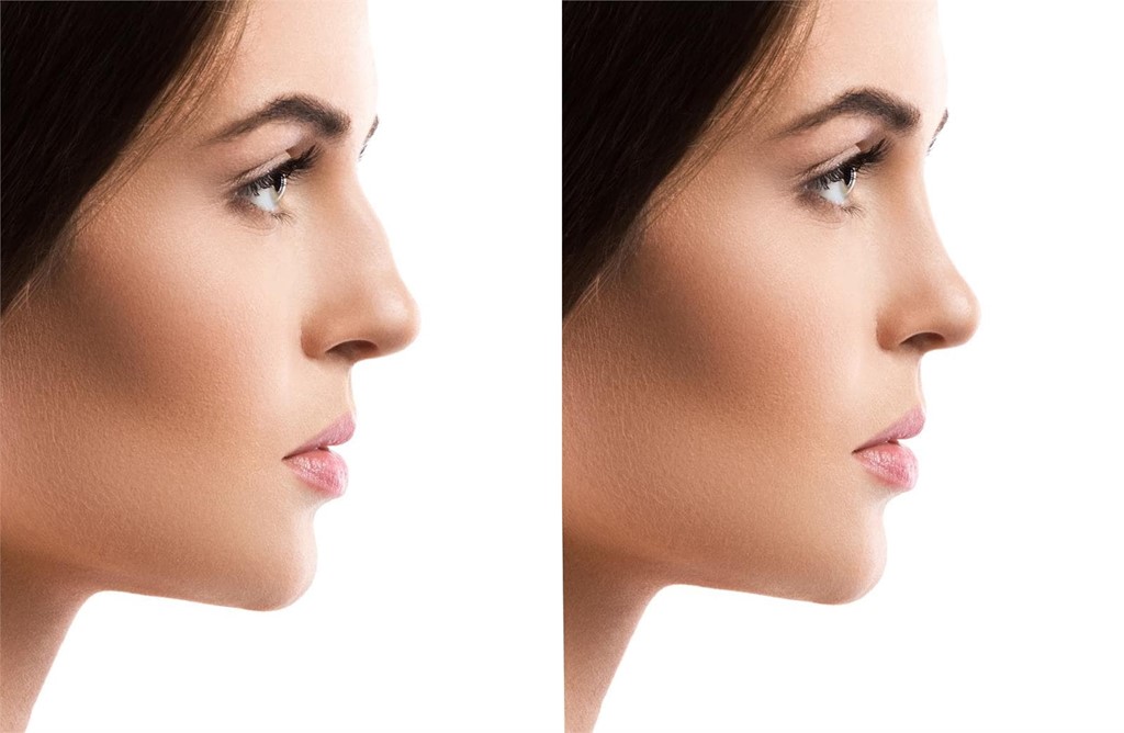 Gana confianza mejorando el aspecto de tu nariz 