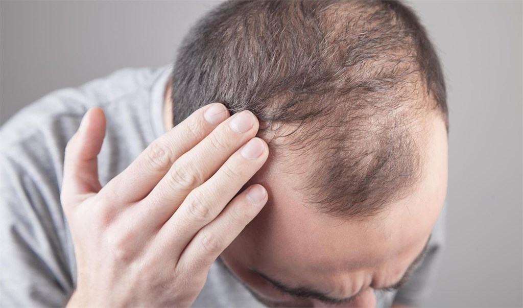 ¿Cómo tratar la caída del cabello de manera efectiva?