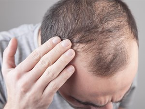 ¿Cómo tratar la caída del cabello de manera efectiva?