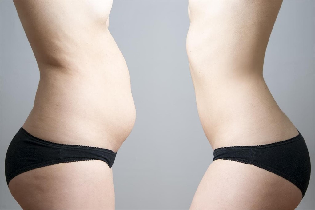 ¡Consigue el abdomen que sueñas con una abdominoplastia! 