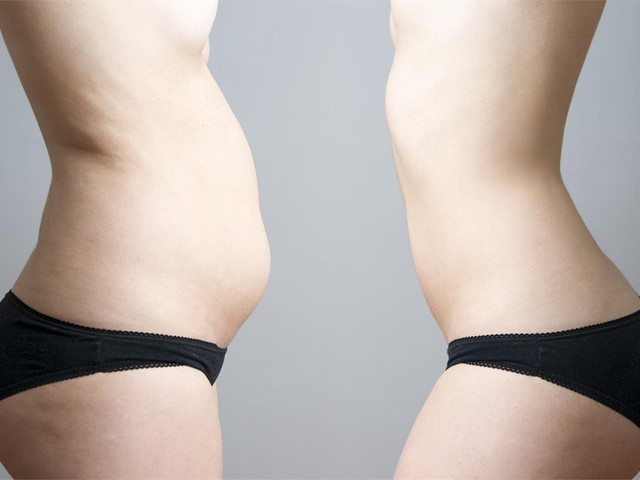 ¡Consigue el abdomen que sueñas con una abdominoplastia! 