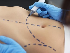 ¿Es posible hacer una cirugía estética de abdomen después de un embarazo?