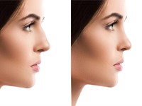 Gana confianza mejorando el aspecto de tu nariz 