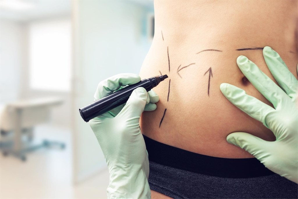 ¿La liposucción adelgaza? La diferencia entre perder peso y perder volumen