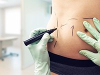 ¿La liposucción adelgaza? La diferencia entre perder peso y perder volumen