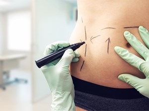 ¿La liposucción adelgaza? La diferencia entre perder peso y perder volumen