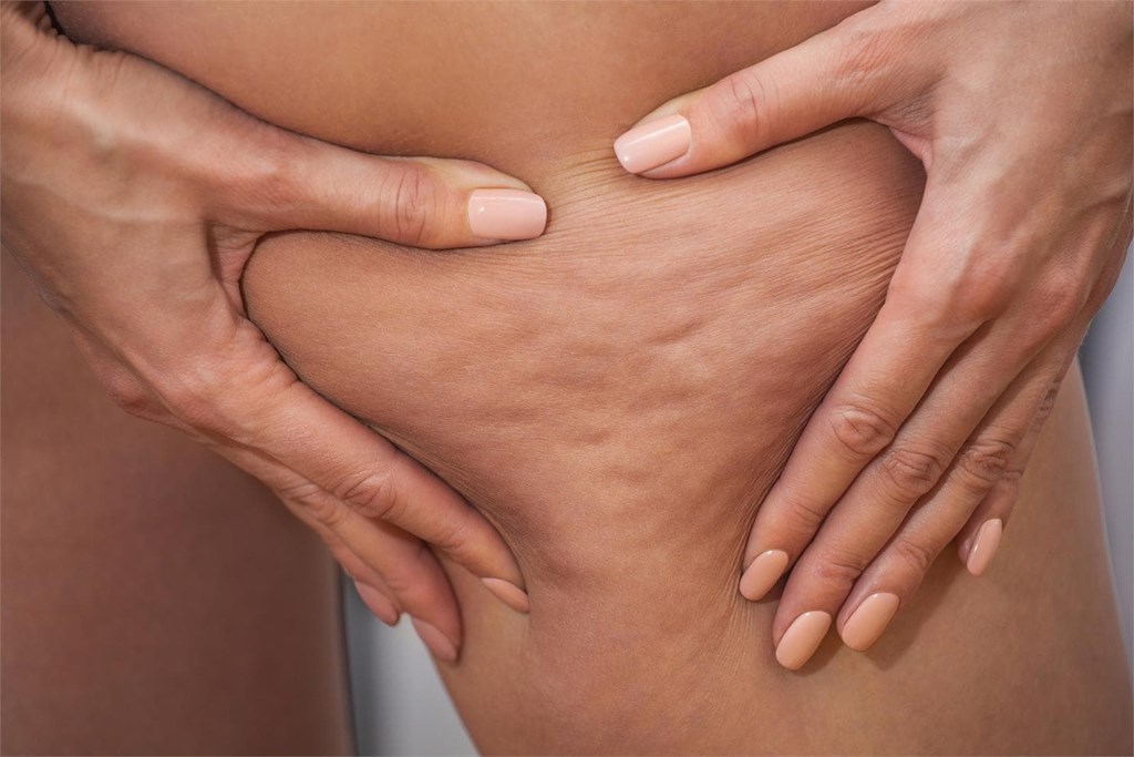 La mesoterapia para la celulitis: ¿realmente funciona?