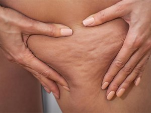 La mesoterapia para la celulitis: ¿realmente funciona?