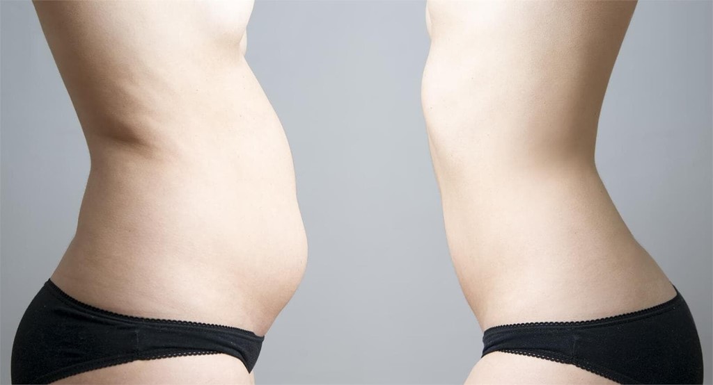 ¿Qué tipos de abdominoplastia existen?