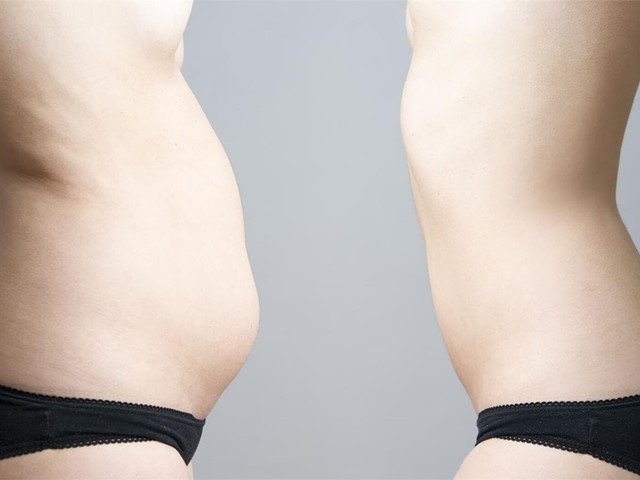 ¿Qué tipos de abdominoplastia existen?